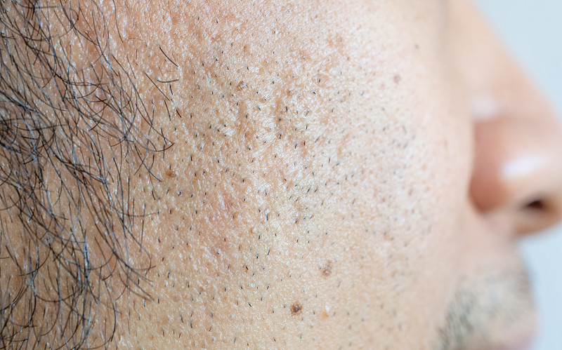 男人的臉部有各種各樣的皮膚問題(如痤瘡、皺紋、毛孔和魚尾紋等)。圖片素材