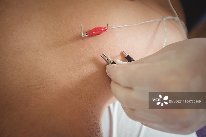 在病人背部进行电干针刺的物理治疗师图片素材