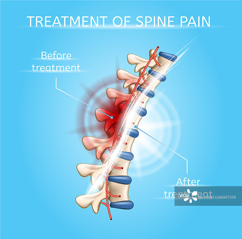 脊柱疼痛治疗真实感图表图片素材