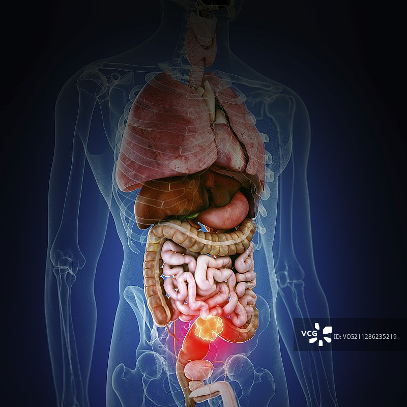 结肠癌示意图图片素材