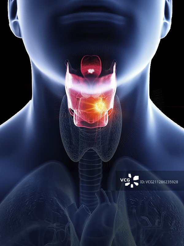 一个男人喉癌的插图图片素材