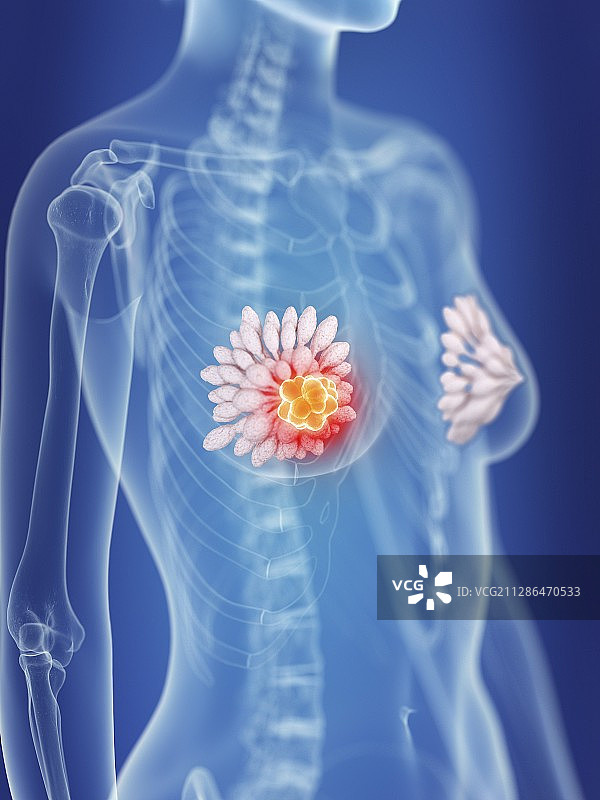 图示:一位妇女的乳腺癌图片素材