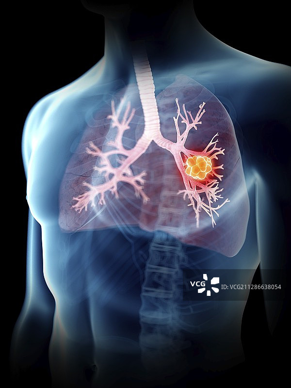 一个男人的肺肿瘤的插图图片素材