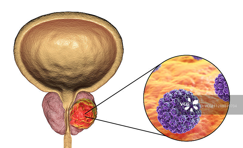 前列腺癌的病毒病原学，概念说明图片素材