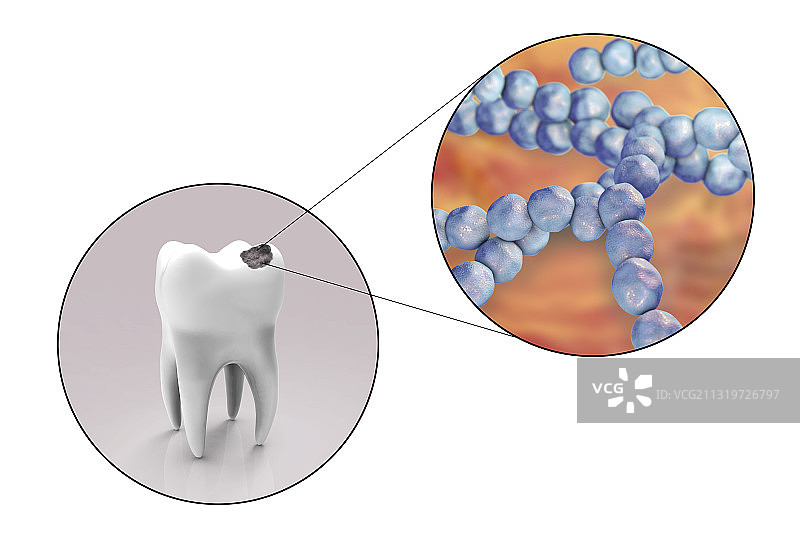 蛀牙和导致龋齿的细菌，艺术品图片素材