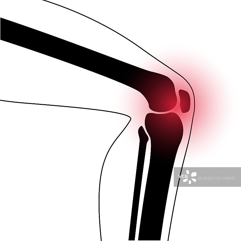 膝关节关节炎图片素材