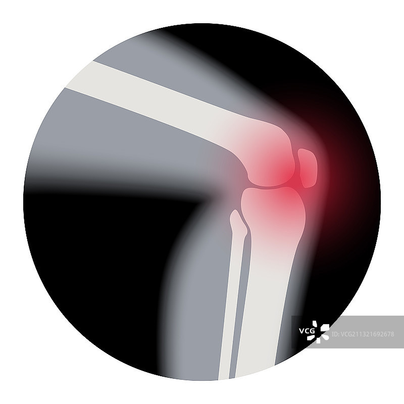 膝关节关节炎图片素材