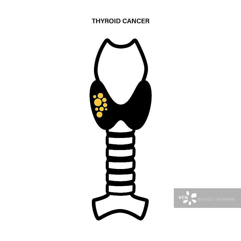 甲状腺癌阶段图片素材