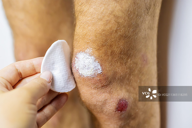 男子腿部受伤，伤口和血液需要处理选择性聚焦图片素材