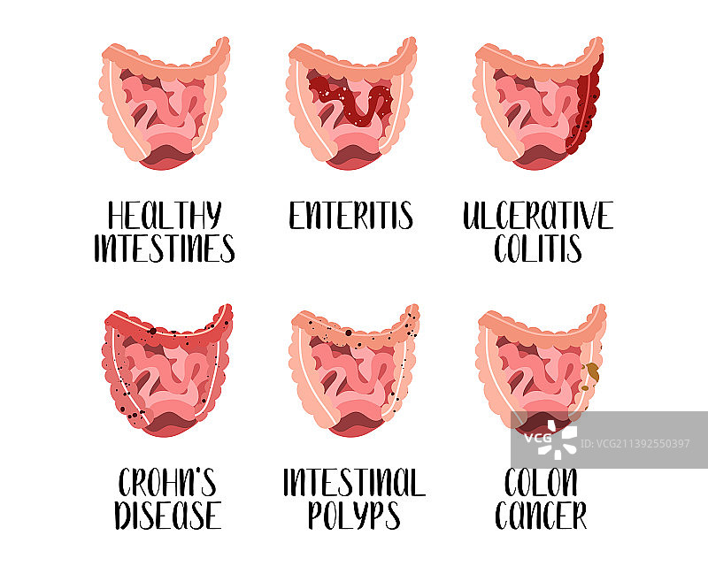 肠道疾病溃疡性肠炎图片素材