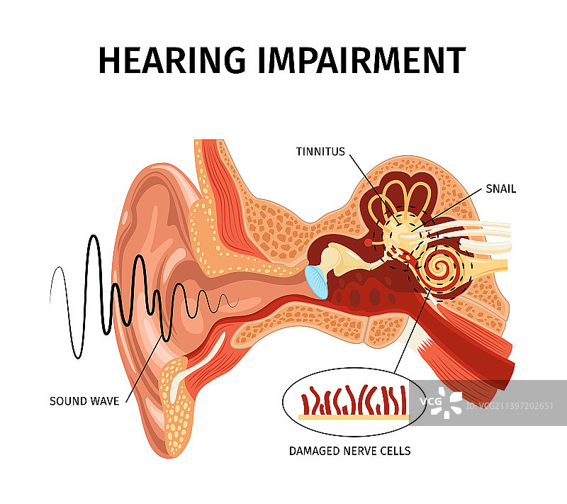 听力损伤解剖组成图片素材