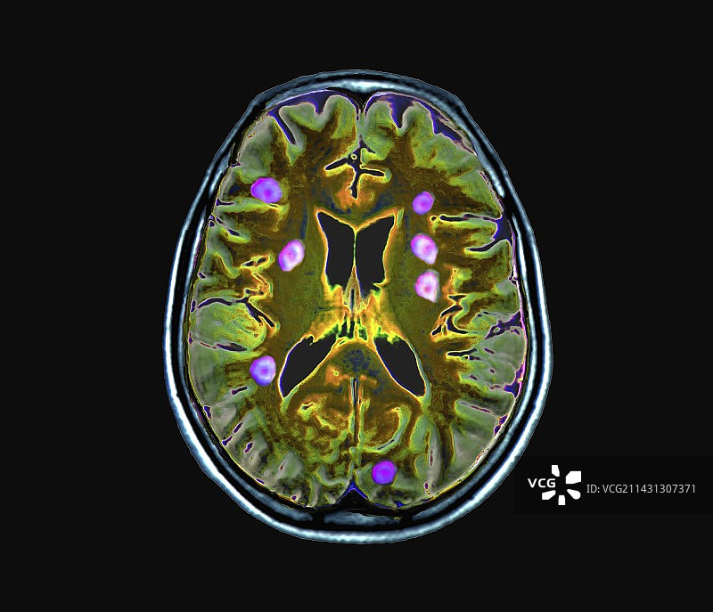 继发性脑癌，MRI扫描图片素材