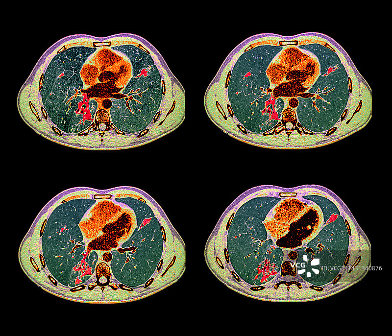 肺结核，CT扫描图片素材