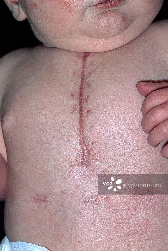 婴儿心脏手术后的疤痕图片素材