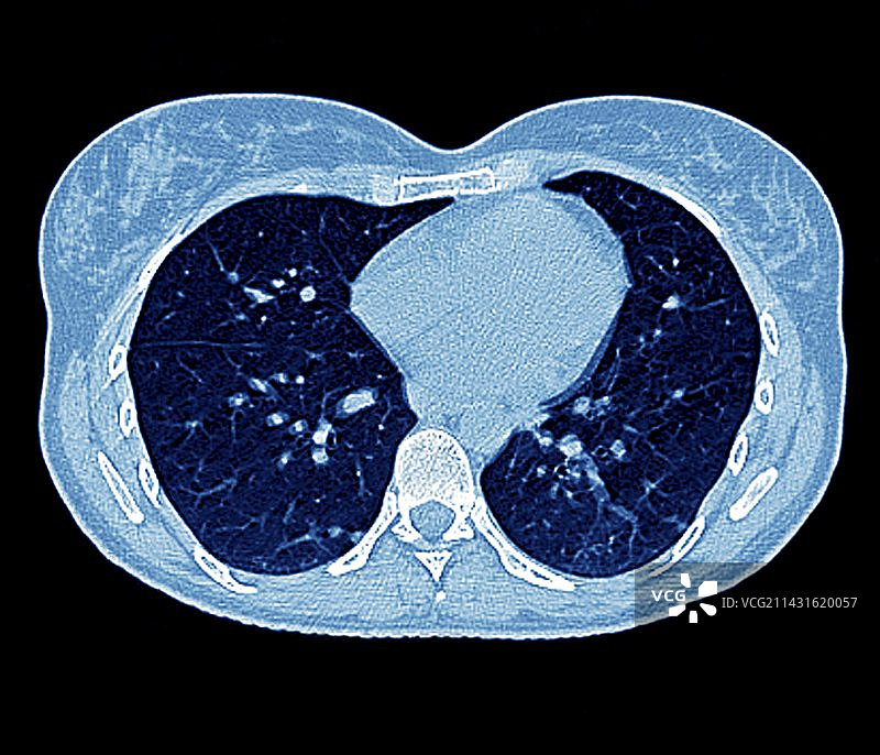 继发性肺癌，CT扫描图片素材
