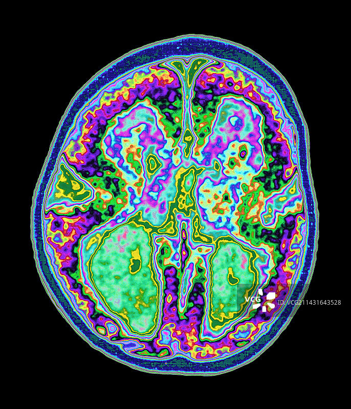 彩色MRI脑部扫描显示无脑畸形图片素材