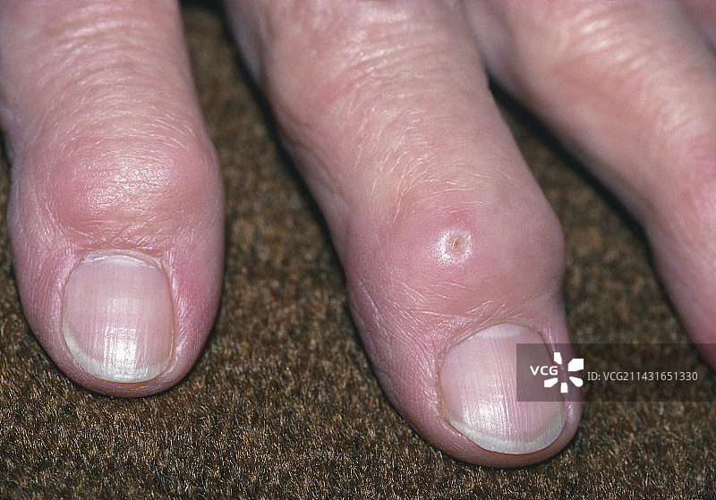 类风湿性关节炎导致手指畸形图片素材