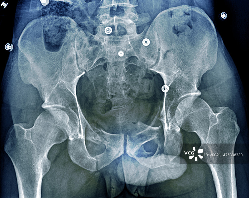 骨盆骨折x线检查图片素材
