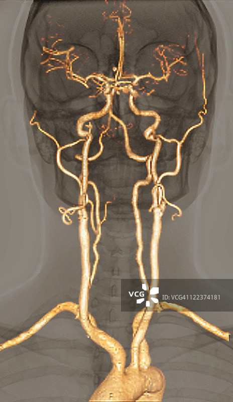 正常动脉，3D CT扫描图片素材
