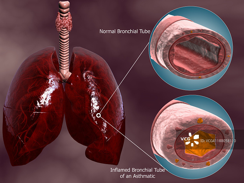 肺气管切面，显示正常和哮喘细支气管的比较。图片素材