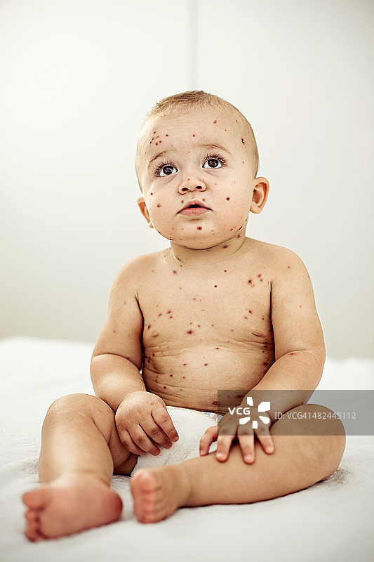 患水痘的婴儿图片素材