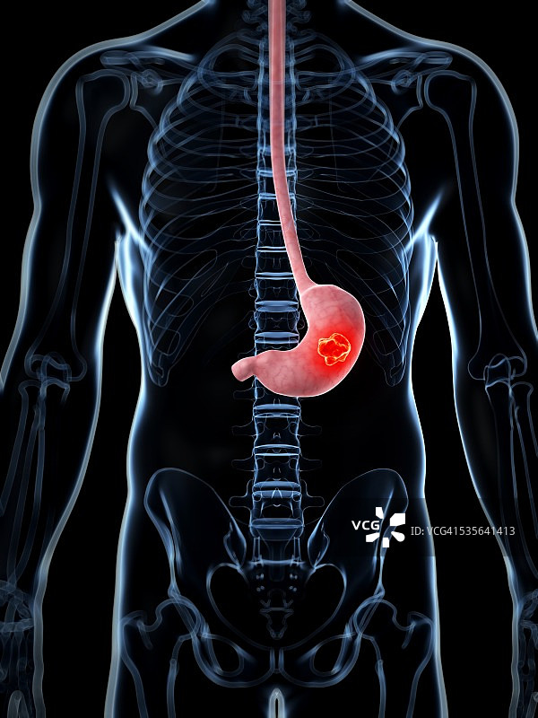 人类胃癌，例证图片素材