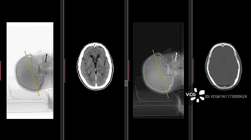 脑CT扫描(头部计算机断层扫描)高分辨率图片素材