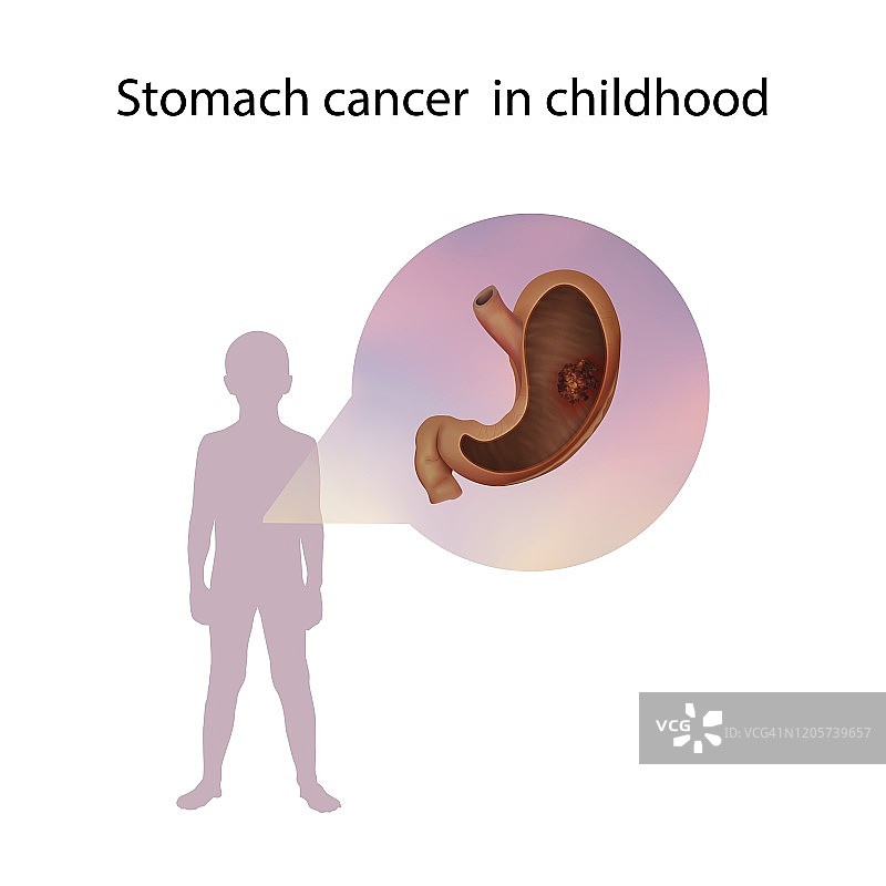胃癌在儿童，插图图片素材