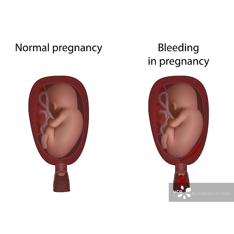 妊娠出血，插图图片素材