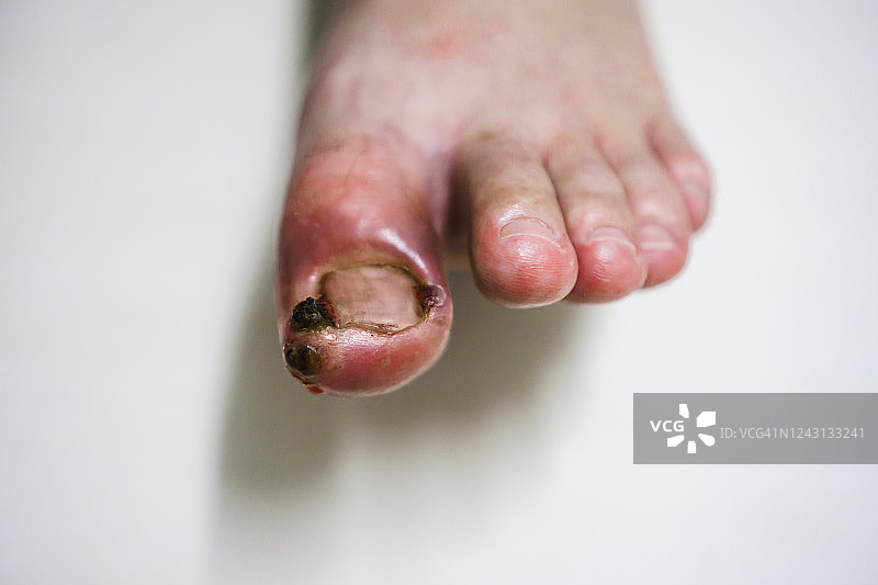 感染内生脚趾甲的特写图片素材