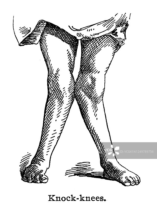 古镌刻各种骨关节疾病的插图，膝内翻图片素材