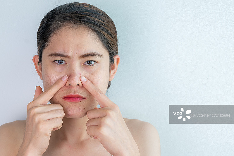肖像亚洲妇女指出痤疮和老化的疤痕问题出现在她的脸上。图片素材