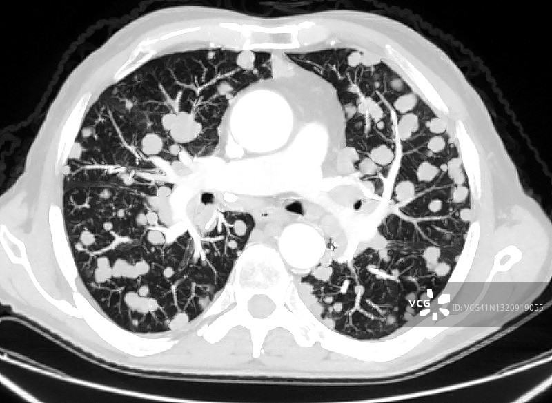CT扫描显示肺部恶性多发转移，轴位面图片素材