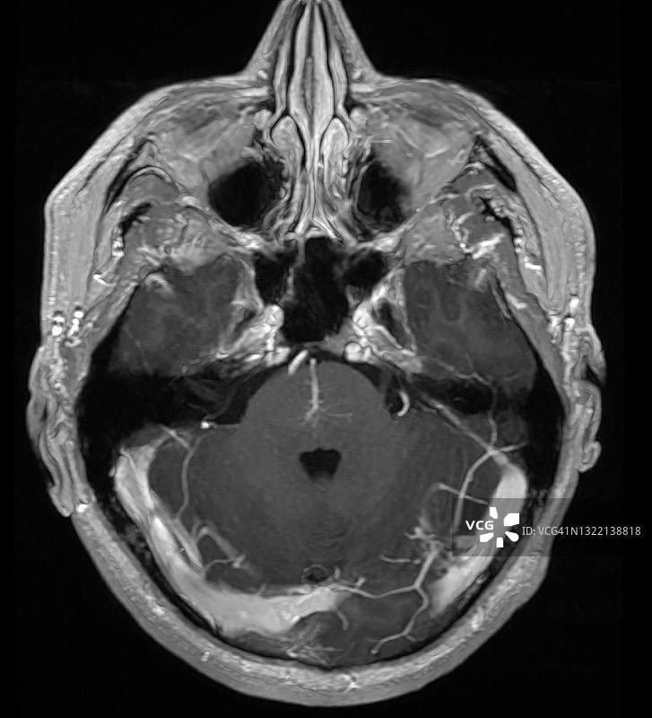发育性静脉异常(DVA)，脑桥脑静脉血管瘤，MRI轴位扫描图片素材
