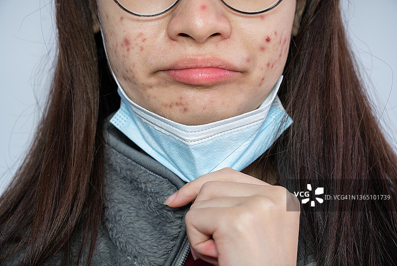 近距离的年轻亚洲妇女打开她的口罩，显示痤疮问题出现在她的皮肤上，因为长期戴口罩。这种情况被称为“面膜痤疮”。图片素材