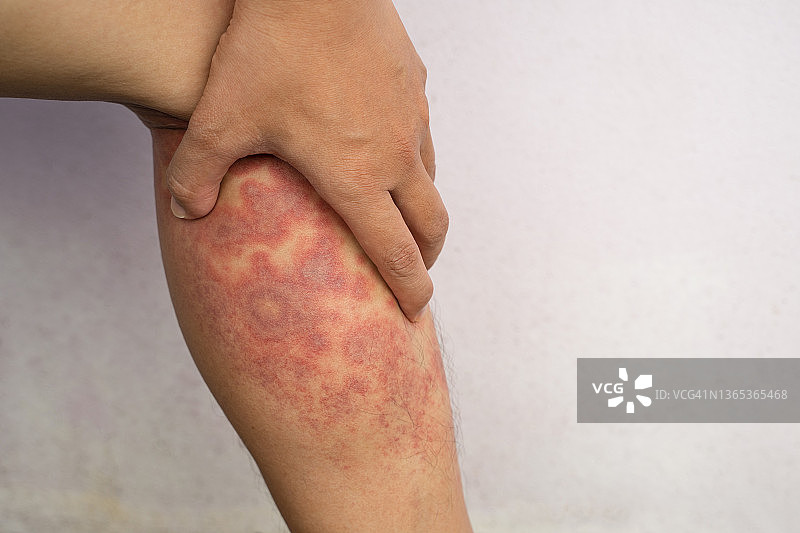 腿上的急性特应性皮炎，一个患有严重湿疹的青少年腿上的红色，发炎，鳞状皮疹。图片素材