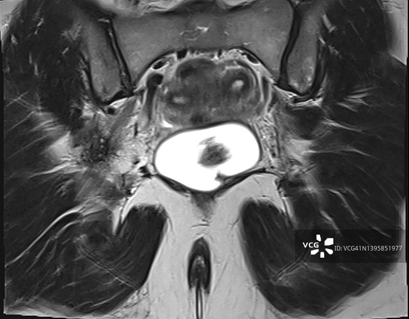 MRI T2图像见双圆子宫(双子宫)图片素材
