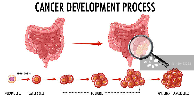 图示癌症发展过程图片素材