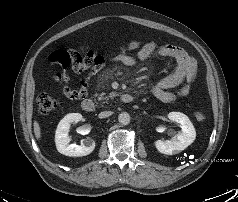 硬化性肠系炎(脂膜炎)的CT表现，轴位图图片素材