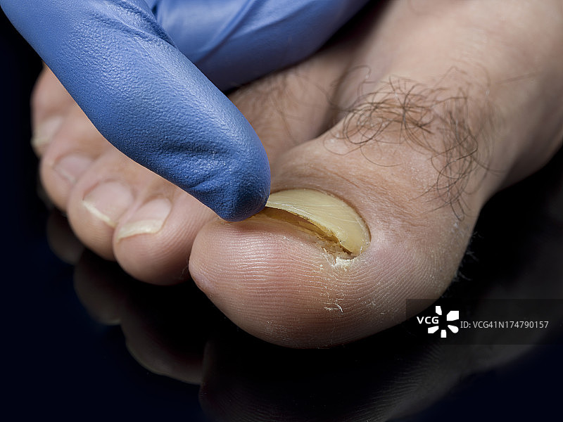 脚趾甲真菌图片素材