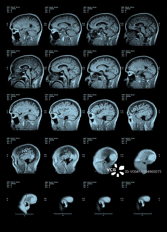 MRI头部扫描侧视图图片素材