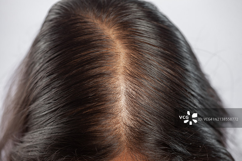 一个女人的微距镜头显示她的秃顶部分由于脱发图片素材