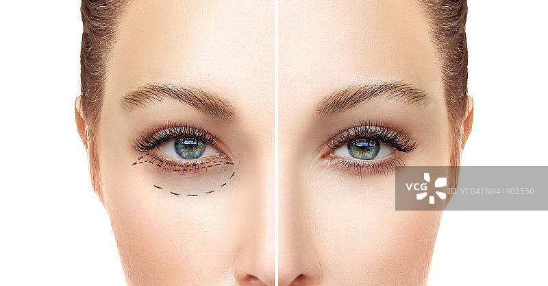 眼睑整容术。眼睑整容术。标志着脸。女性面部穿孔纹，整形外科概念。图片素材