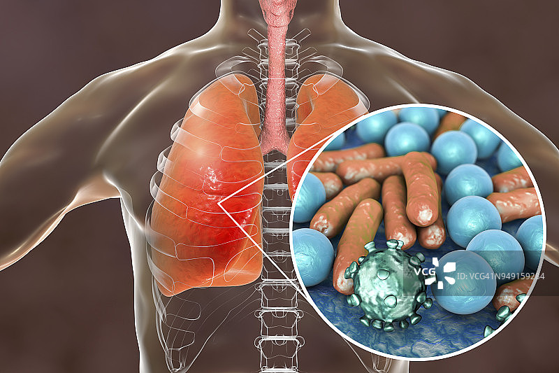 肺炎，医学概念，展示人类肺部的插图和肺部微生物的近景图片素材