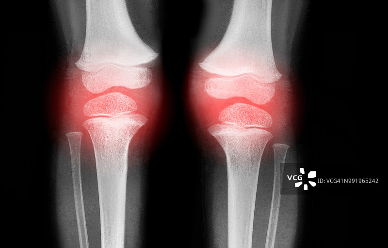 膝关节炎图片素材