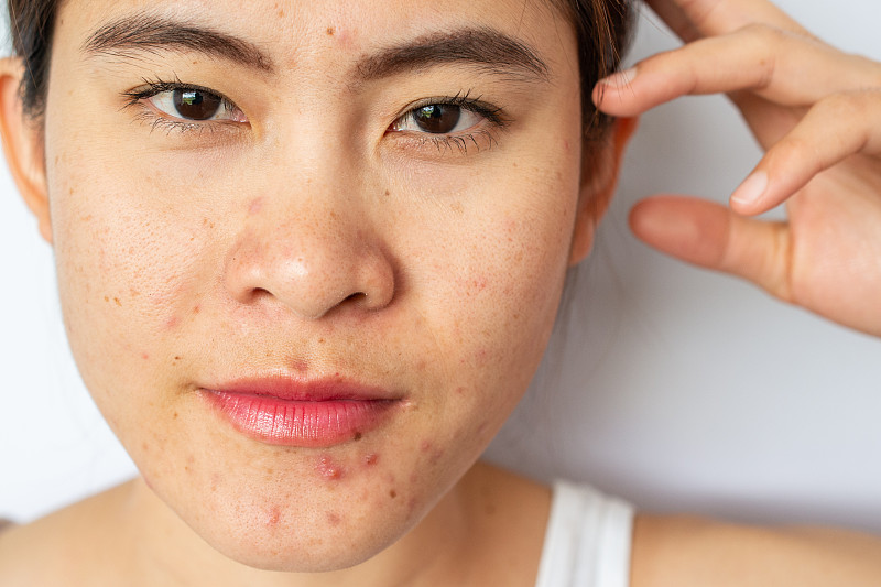 近距离的女人面对痤疮和疤痕的问题从痤疮炎症(丘疹和脓疱)在她的脸上和她看相机。图片下载