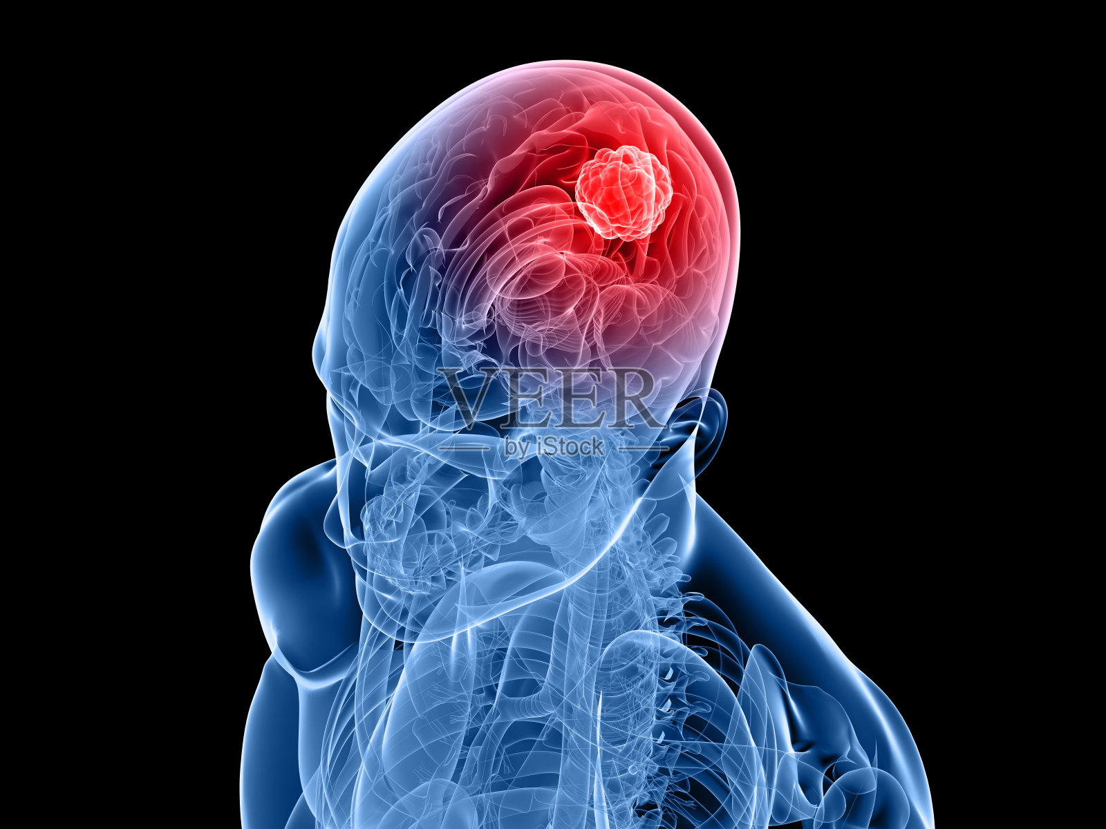 一幅描绘癌症的人类头骨和大脑的3d图像插画图片素材