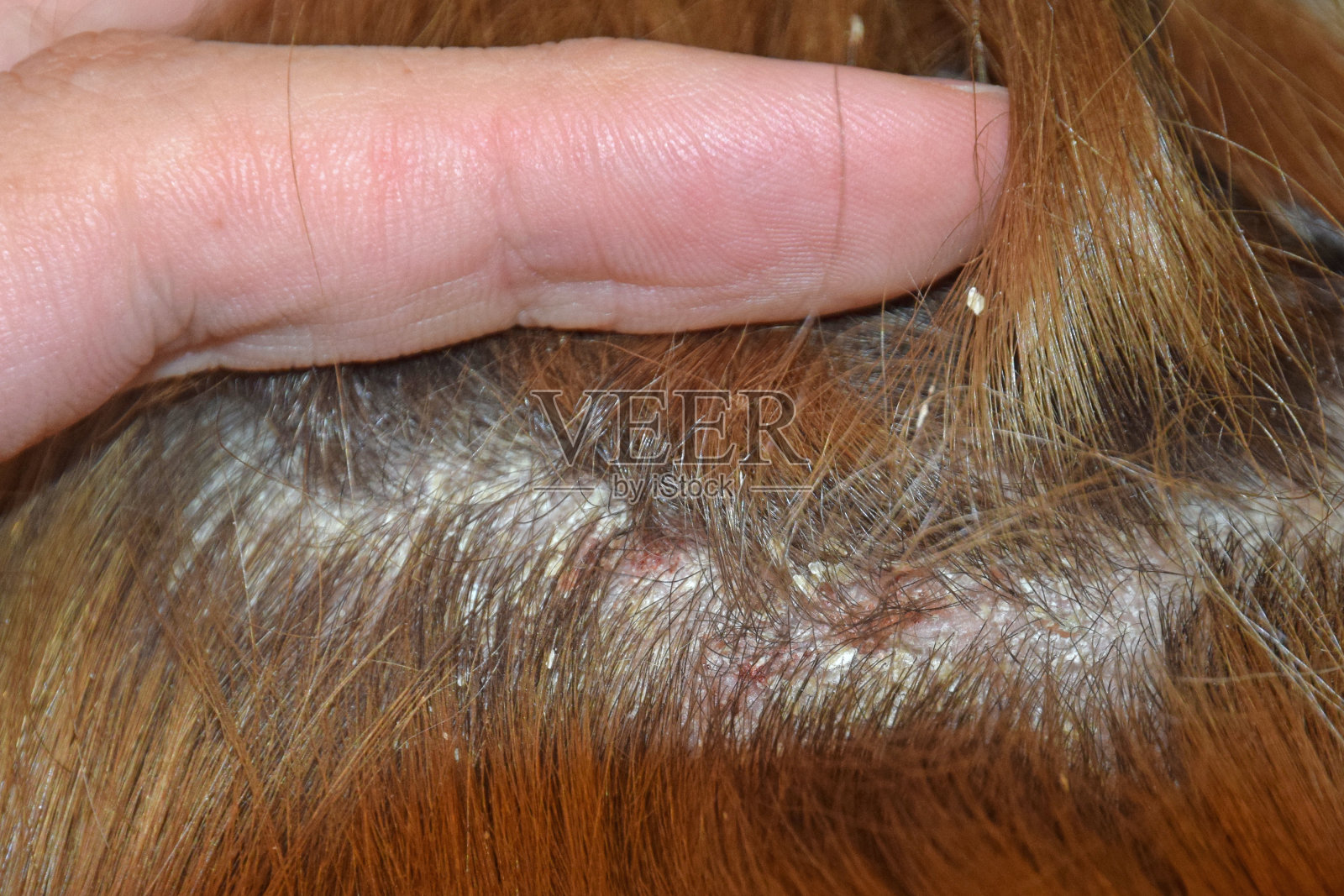 牛皮癣皮肤疾病照片摄影图片