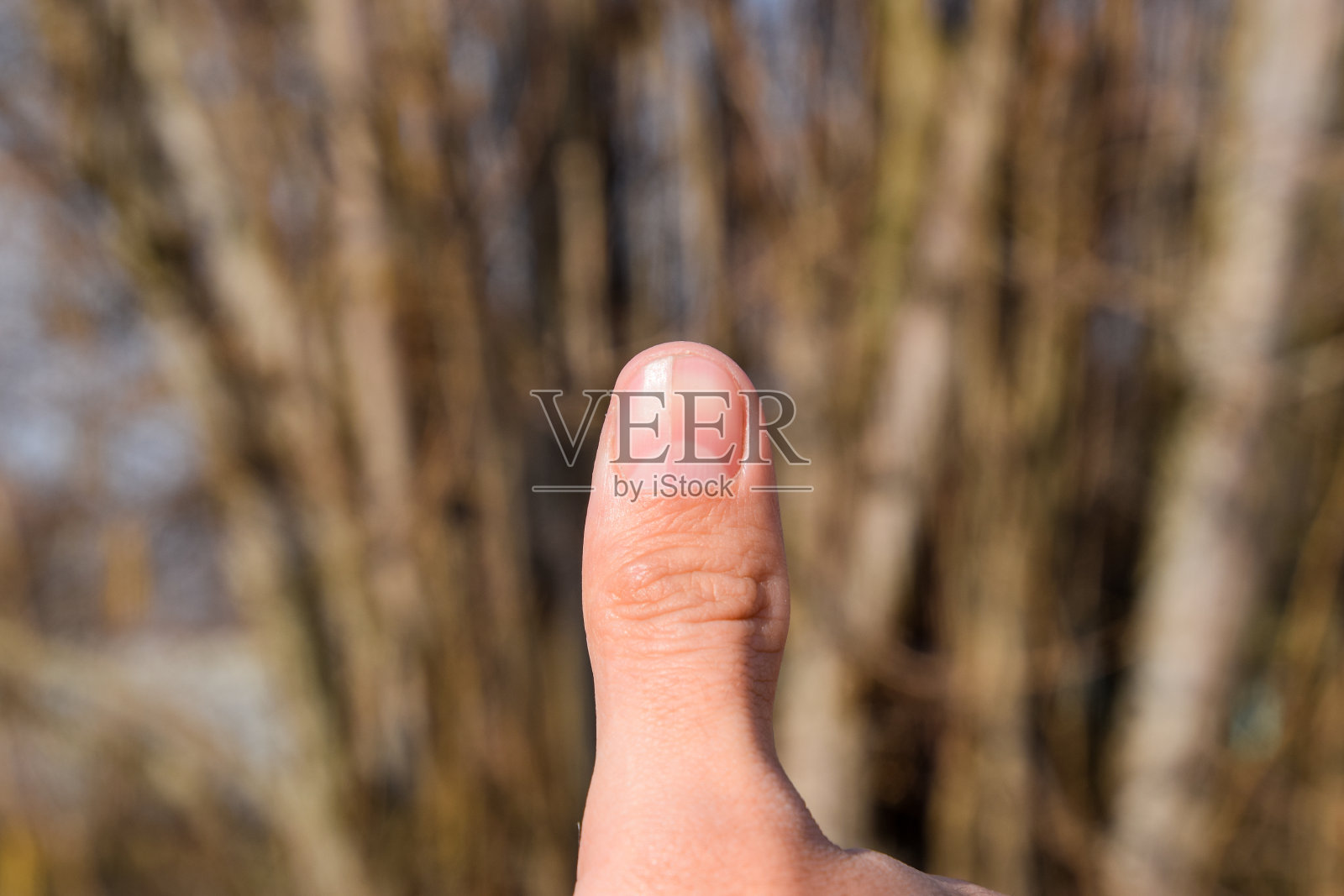 拇指上的叉形指甲。指甲扩张，创伤性病理。钉子被分成两半照片摄影图片