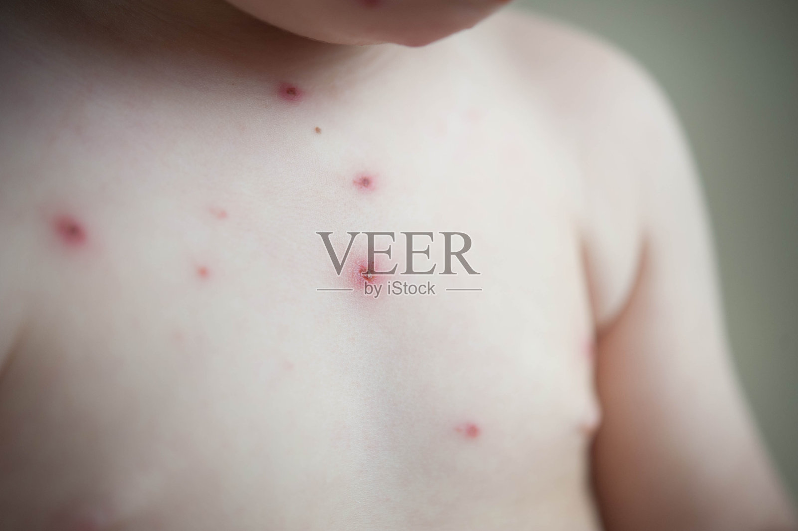 水痘——疾病照片摄影图片